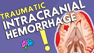 Intracranial Hemorrhage [upl. by Notneiuq]