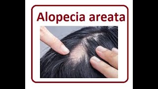 Alopecia Areata Causes  2024 [upl. by Crenshaw]