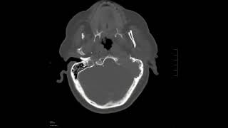 Skull base mass [upl. by Kosel]