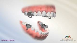 Orthodontic Treatment for Overjet Overbite  MARA Appliance [upl. by Ymmas]