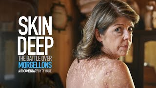 Skin Deep The Battle Over Morgellons  Trailer [upl. by Aneehsak579]