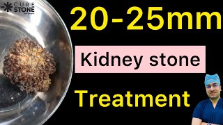 2025 mm Kidney Stones का उपचार  2025 mm Kidney Stones Treatment  किडनी स्टोन का इलाज rirs [upl. by Hancock]