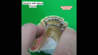 Denture with Metal Framework l Cast Partial [upl. by Noak534]