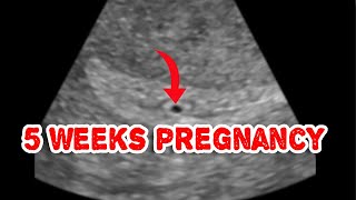 Early pregnancy sac on ultrasound Intradecidual sac sign [upl. by Airtened]