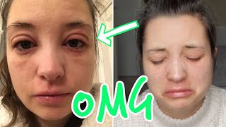 ALLERGIC REACTION  SWOLLEN EYES  ECZEMA FLARE UP  INFECTED ECZEMA [upl. by Bravar]