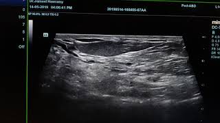 Fibrocystic Breast Disease Sonography [upl. by Idolah99]