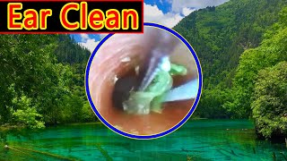 Ear wax removal amp Ear Cleaning （11） [upl. by Nosoj529]