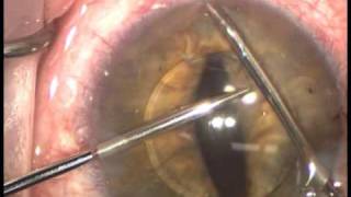 AHMED Repositioning of intraocular lens to iris suture fixation [upl. by Notelrahc587]