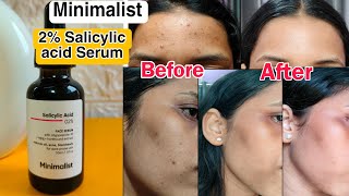 Minimalist 2 Salicylic acid Face Serum  My Honest Review  How I cleared my Skin✅ [upl. by Thierry]