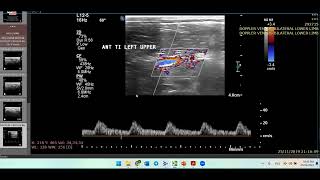 Thromboangitis ObliteransHow to ThinkDoppler Ultrasound Case [upl. by Annauqaj]