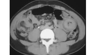 Multiple Intussusception with lymphoma patient [upl. by Eiznekcm]