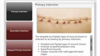 Types of Wound Closure [upl. by Mcmillan248]