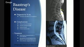 Pathophysiology of Lordotic Back Pain in Athletes [upl. by Ahsaeym5]