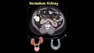 Horseshoe kidney Anatomy CT scan findings medicalschool ctscan 3danatomy lowerlimb 3dmodel [upl. by Benildas]