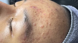 ACNE TREATMENT VU QUYNH MI  Blackheads Perennial EveryWhere Squeeze Forehead [upl. by Evered]