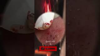 blackheads and whiteheads removal  severe cystic acne extraction  ACNE REMOVAL [upl. by Ahcire]