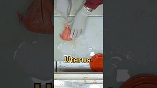 uterus with bilateral adnexa specimen [upl. by Accemahs560]