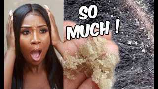 REACTING TO EXTREME DANDRUFF SCRATCHING  Home Remedies For Dandruff Removal [upl. by Horsey]