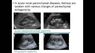 Ultrasound of renal parenchymal diseases [upl. by Edniya819]