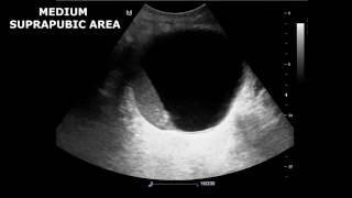 Renal Ultrasound in Etiology of Acute Kidney Failure  A Case Report [upl. by Orlantha]