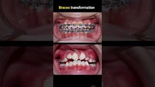 Braces transformation in 20 seconds dentist smile teethwhitening beauty braces [upl. by Levania]