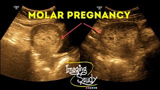 Molar Pregnancy  Hydatidiform Mole  Gestational Trophoblastic Disease  Ultrasound  Case 38 [upl. by Ariajay]