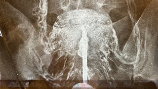 Asherman Hydrodissection Total reconstruction by Osama Shawki [upl. by Ahso]