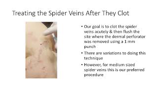 Treating Spider Vein Complexes Using a Combination of Tumescent amp Foam Sclerotherapy [upl. by Cazzie]