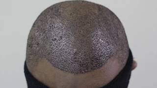 FUE Greffe de cheveux Afro  Dr Arslan [upl. by Terces]