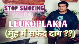 Leukoplakia Causes Symptoms Management amp Treatment  मुंह में सफेद और लाल दाग़ होना [upl. by Lomax]