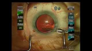 Safe And Easy Modern Cataract Surgery 5 minute procedure  Louisville KY Albert Smolyar [upl. by Nylloc298]