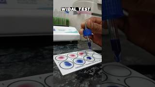 WIDAL test 😱 कैसे करते हैं देखो negative positive typhoid trending viral sorts [upl. by Burg323]