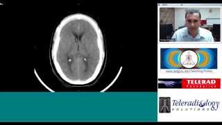 Subarachnoid Hemorrhage radiology teaching by Dr Arjun Kalyanpur [upl. by Camarata]