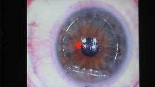 Lasik Femto 100 laser myopie Centre Vision Laser Paris Ouest [upl. by Alleciram649]