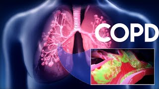 Chronic Obstructive Pulmonary Disease COPDUnit5Pulmonary NursingAHNII Bsn 4rth [upl. by Kaz]