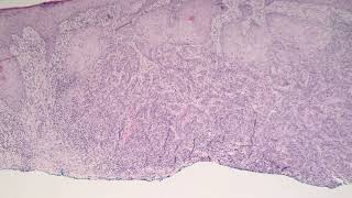 Squamous Cell Carcinoma Moderately Differentiated [upl. by Ehc692]