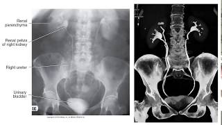 Radiographic Contrast Studies of the Urinary System [upl. by Marijane485]