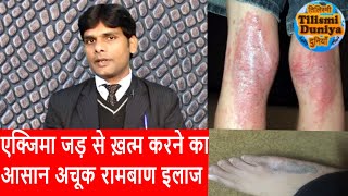 Eczema Treatment In Hindi  Fungal infectionएक्जिमा दाद खाजखुजली का आसान अचूक इलाज [upl. by Swithbart376]