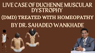 quotLive Case of Duchenne Muscular Dystrophy DMD Treated with Homeopathy BY DR SAHADEO WANKHADE [upl. by Vanden]