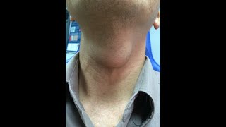 What is Thyroglossal Duct Cyst Symptoms Causes Treatment Diagnosis [upl. by Ydaj]