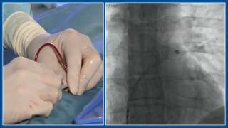 PFO Closure [upl. by Pierce]