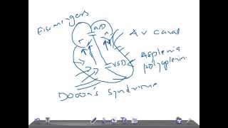 Medical Video Lecture Subendocardial cushion defects [upl. by Tdnaltroc971]