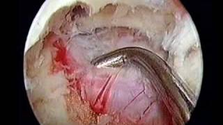 Endoscopic Lumbar Discectomy [upl. by Riesman]