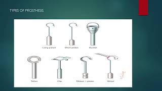 Otosclerosis Department of ENT  Santhiram Medical College [upl. by Ahsekar]