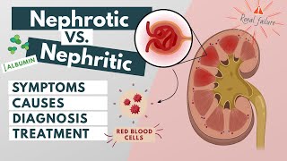 Nephrotic vs Nephritic syndrome  Symptoms diagnosis causes treatment  Visual explanation [upl. by Thirzia329]