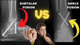 Subtalar Fusion vs Ankle Fusion Are They The Same [upl. by Nnoved]