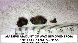 MASSIVE AMOUNT OF EAR WAX REMOVED FROM BOTH EAR CANALS  EP 65 [upl. by Jermayne]