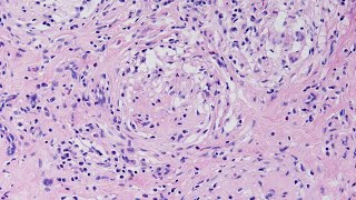 A Case of Granulomatous Orchitis  Pathology mini tutorial [upl. by Ajed905]