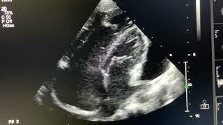 Moderate Pericardial Effusion with Sinus Venosus ASD SVC type [upl. by Asiuqram]