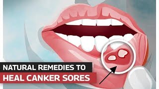 How To Treat Canker Sores  Mouth Sores Treatment [upl. by Tresa579]